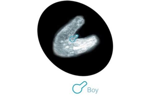 3 lines on pregnancy ultrasound: does it show your baby's sex? | MadeForMums