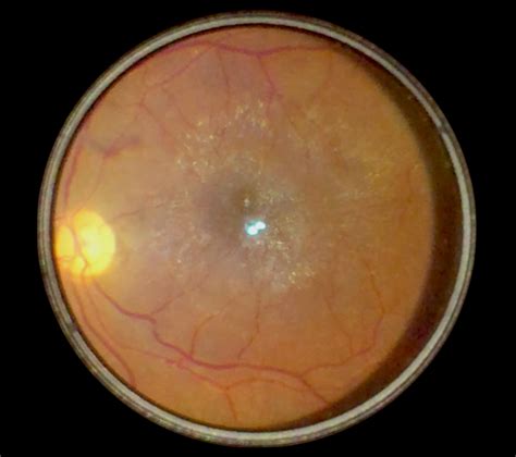 Epiretinal Membrane Fundus Photo