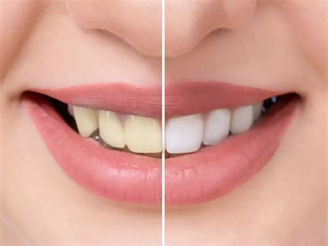 How to whiten your teeth with common kitchen ingredients | The Times of ...