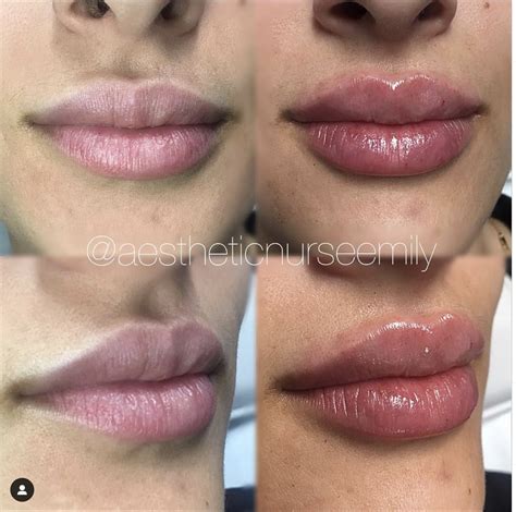 Restylane Versus Juvederm For Lips | Lipstutorial.org