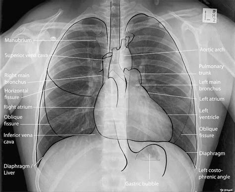 Normal Chest X-Ray • LITFL Medical Blog • Labelled Radiology