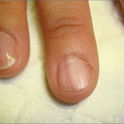 Painful nail with longitudinal erythronychia | MDedge Family Medicine