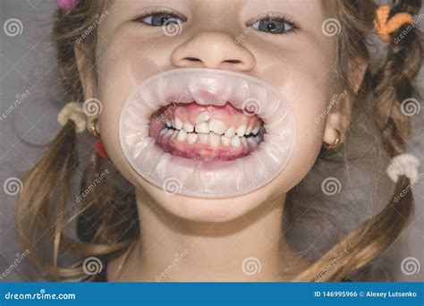 Adult Permanent Teeth Coming In Front Of The Child`s Baby Teeth: Shark Teeth Royalty-Free Stock ...