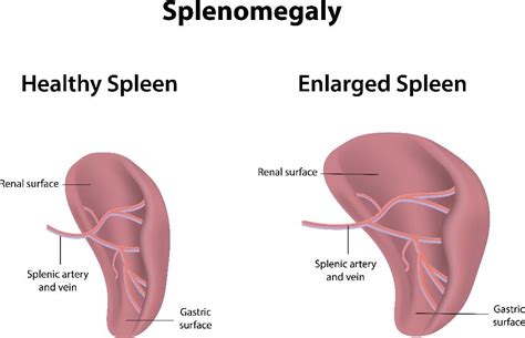 10 Facts About Splenomegaly - Facty Health