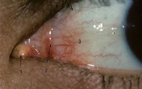 Lacrimal Caruncle