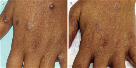 Treatment of Refractory Prurigo Nodularis With Lenalidomide ...