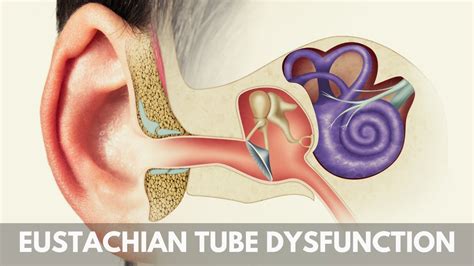 Eustachian Tube Dysfunction Remedies