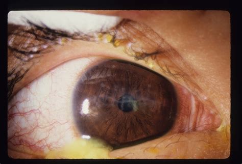 Corneal Laceration / Repeat Trauma - Retina Image Bank