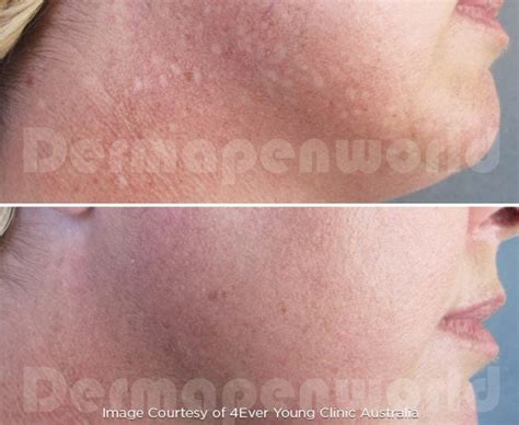 What are White Spots on Skin from Sun? - DermapenWorld