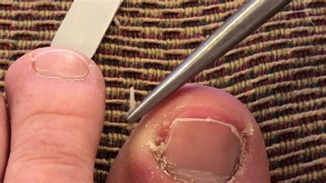 Ingrown Toenail Removal - YouTube