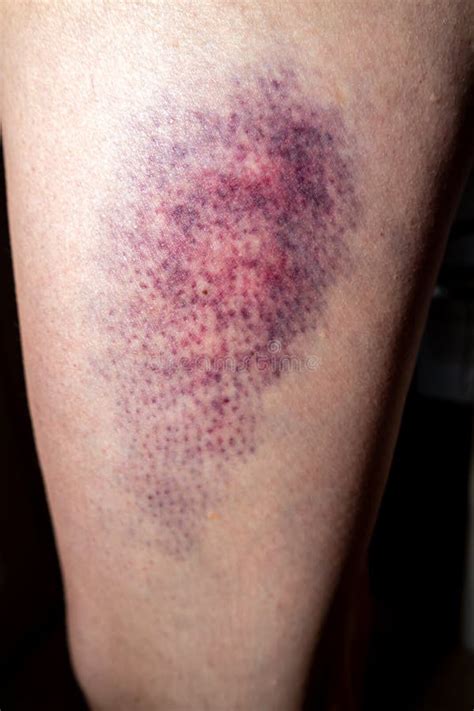 Terrible Bruise on the Upper Leg of a Woman Stock Image - Image of ...