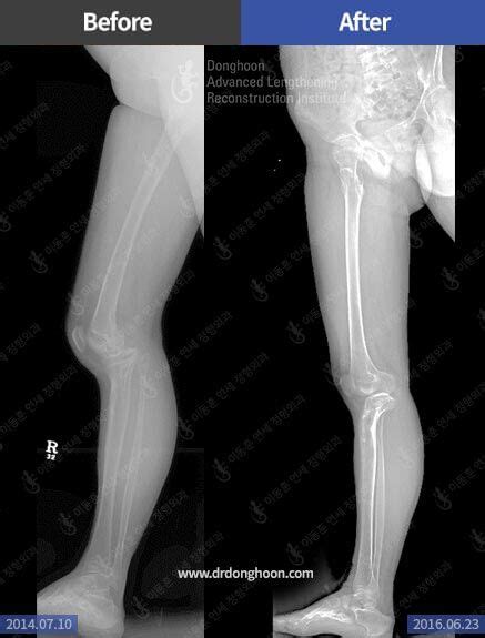 Genu Recurvatum – Limb Lengthening & Complex Reconstruction Service: Korea | DALRI