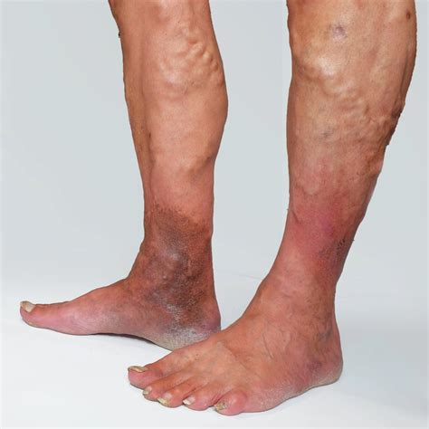 Skin Changes In Venous Insufficiency - Laurel Clinical