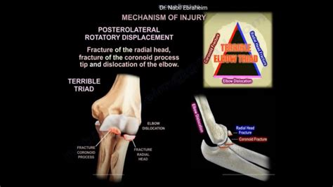 Coronoid Process Fractures — OrthopaedicPrinciples.com