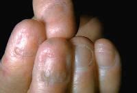 Epidermolysis bullosa