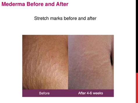 Mederma before-and-after