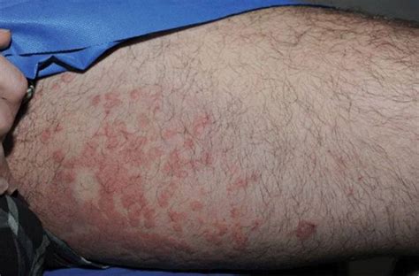 Fungal Rash On Inner Thigh