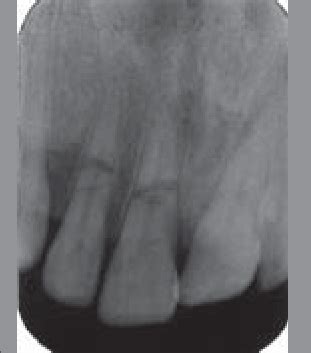 Periapical radiograph showing horizontal root fractures of upper right... | Download Scientific ...