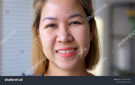 Syringoma Milia Milium Cysts Seborrheic Keratosis Stock Photo 2429371427 | Shutterstock