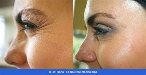 Botox, Dysport and Xeomin Before and After Photos by Dr. Hanna | Ventura