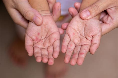 Hand, Foot, and Mouth Disease in Children and Adults