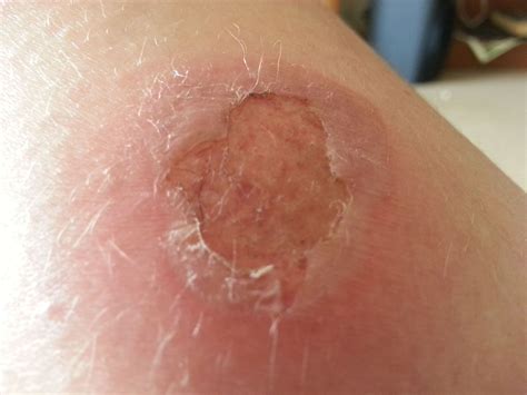 Photo Gallery of Second-Degree Burns (2023)