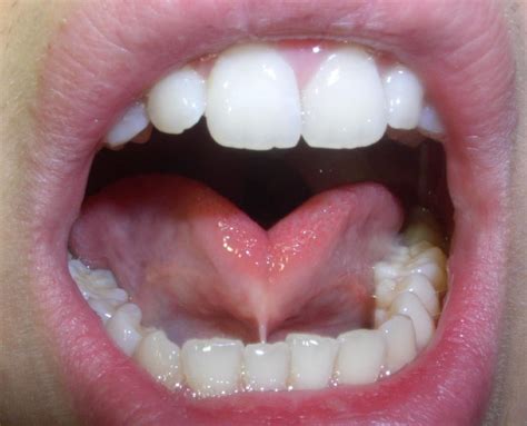 Three Videos of Laser Lingual Frenectomy Procedures | Oral Answers