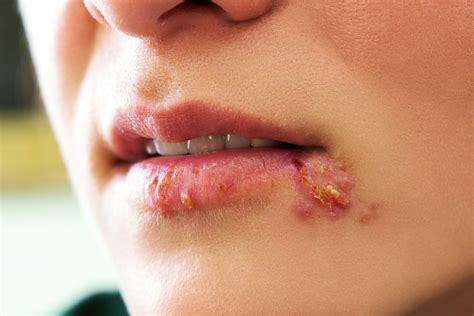 What Does Syphilis Look Like On Lips | Lipstutorial.org