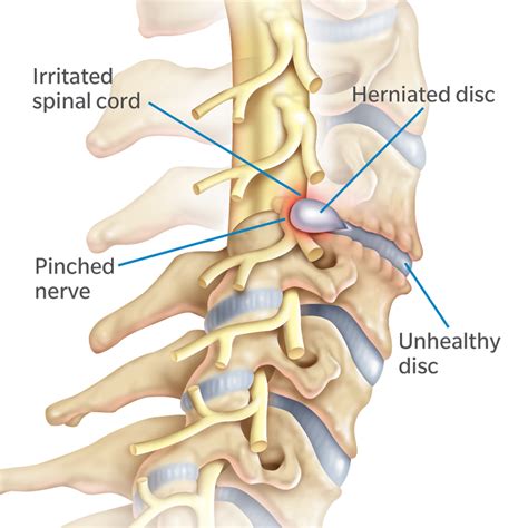 Degenerative C-Spine