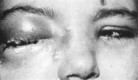 The Ocular Complications of Smallpox and Smallpox Immunization | Infectious Diseases | JAMA ...