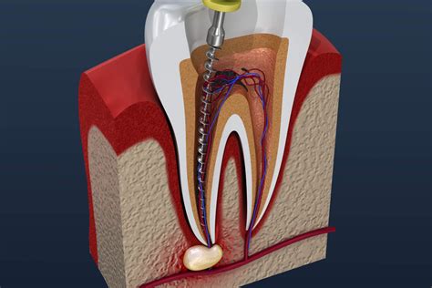 Root canal treatment process. 3D illustration | Hancock Village Dental | Dentist Clermont Florida