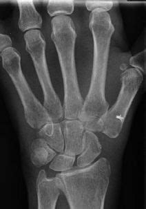 Basilar Thumb Arthritis Arthroscopic LRTI Surgery Hand Surgeon Houston TX | Thumb arthritis ...