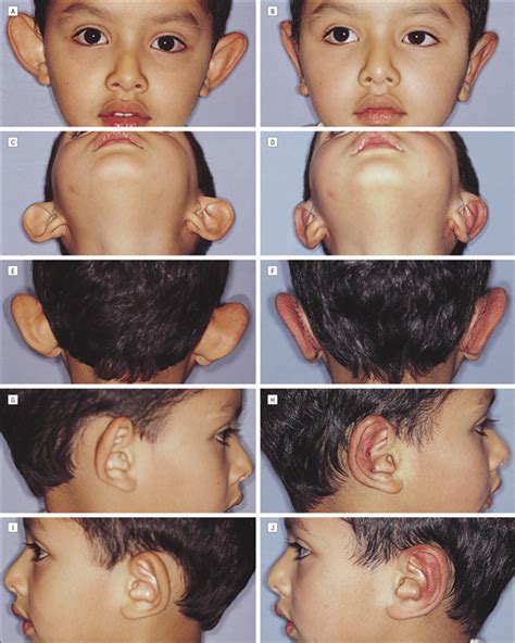 Aesthetic Otoplasty With Remodeling of the Antihelix for the Correction of the Prominent Ear ...