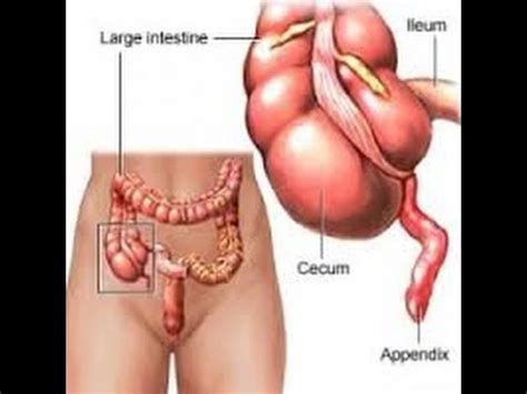 appendicitis pain symptoms in adults - symptoms of appendix - YouTube