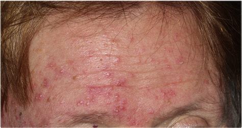 Demodex Mites In Human Skin