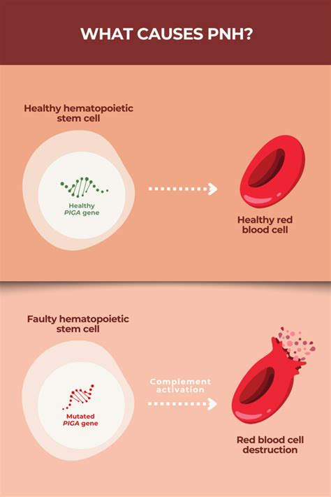 PNH Causes | PNH News