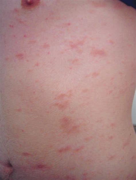 A Boy With a Scaly, Nonpruritic Rash | Consultant360