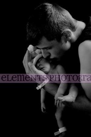 pictures of babies with anencephaly