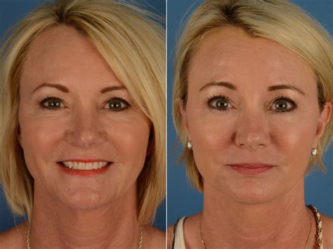 The UpLift™ Lower Face and Neck Lift Photos | Naples, FL | Patient 15169