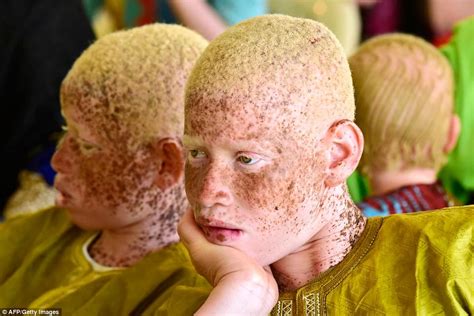 Albinos around world gather for International Albinism Awareness Day - Big World Tale