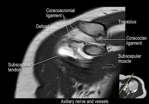 The Radiology Assistant : Shoulder MR - Anatomy | Omuz