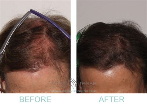 Low level laser therapy hair loss before after