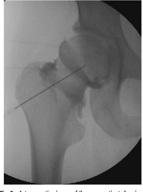 Efficacy of using an air arthrogram for EUA and injection of the hip ...