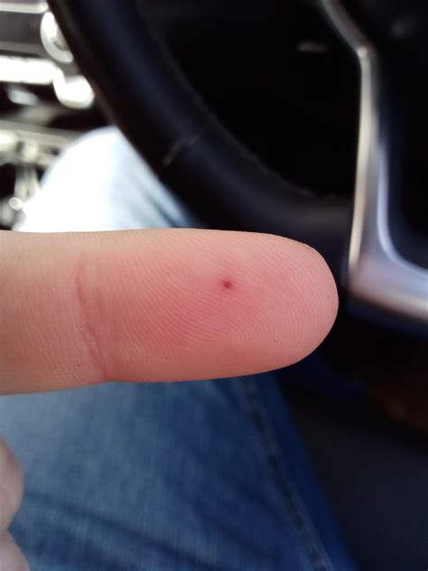 Tiny blood blister : r/mildlyinfuriating