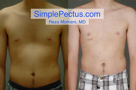 Simple_Pectus_Excavatum_Repair_case01ws — SIMPLE Pectus Excavatum Repair