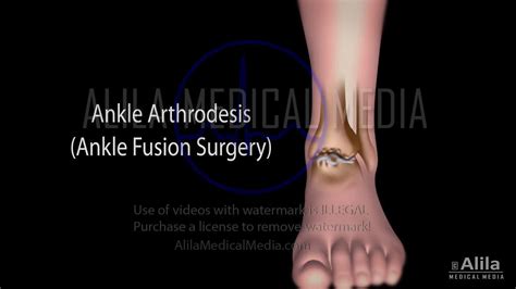 Alila Medical Media | Orthopaedics & Sport Medicine Images & Videos