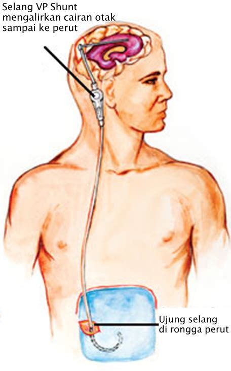 vp-shunt - Brain and Spine Center