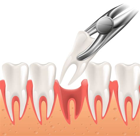 Tooth Extraction Home Care Instructions | Cobblestone Dental Care