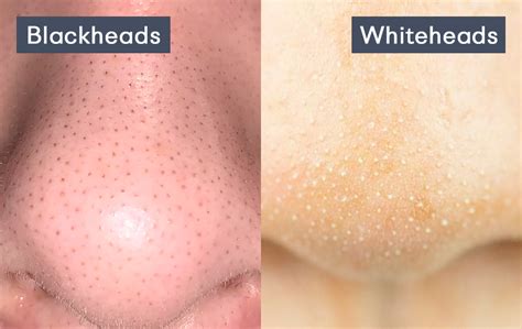 Blackheads vs. Whiteheads: Difference – Muggu SkinCare