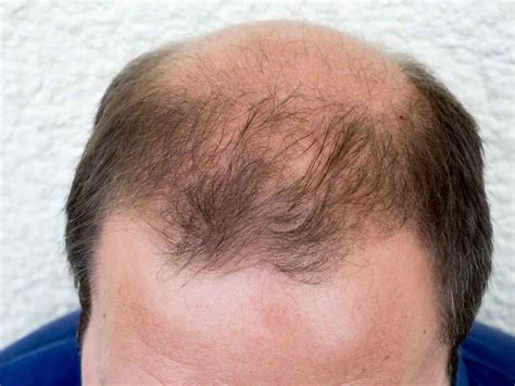 [New Drug Alert] - Concert Pharmaceuticals' drug CTP-543 helped regrow alopecia patients' hair ...
